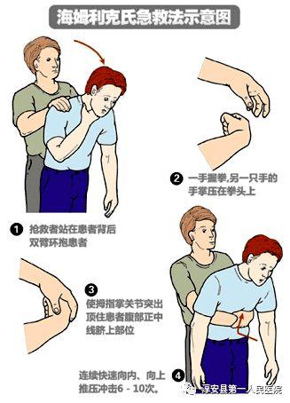 成人卡住气管自救视频,如何快速解困？