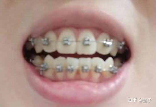 成人牙齿矫正美女视频,跟随牙齿矫正美女视频见证笑容重生