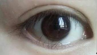 倒睫成人怎么矫正好视频,成人如何轻松改善视力困扰