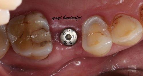 成人换门牙视频过程图解